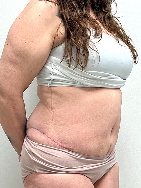 Abdominoplasty Before and After | Rashid Plastic Surgery