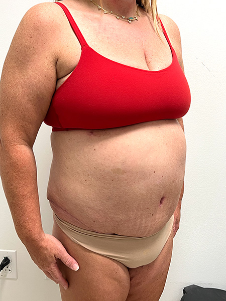 Abdominoplasty Before and After | Rashid Plastic Surgery