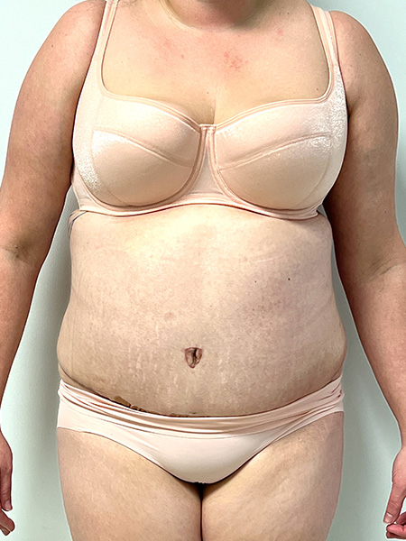 Abdominoplasty Before and After | Rashid Plastic Surgery