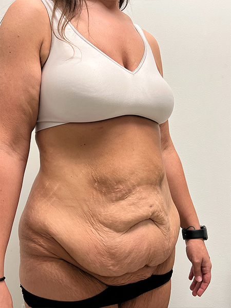 Abdominoplasty Before and After | Rashid Plastic Surgery