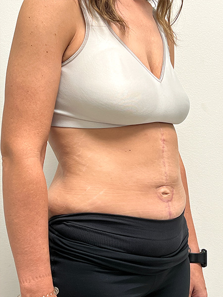 Abdominoplasty Before and After | Rashid Plastic Surgery