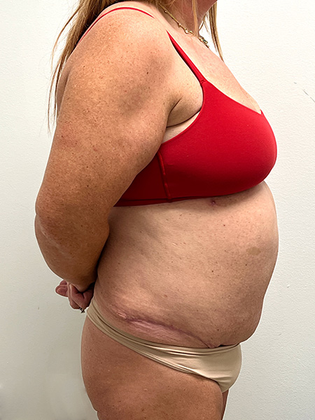 Abdominoplasty Before and After | Rashid Plastic Surgery
