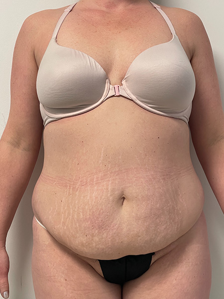 Abdominoplasty Before and After | Rashid Plastic Surgery