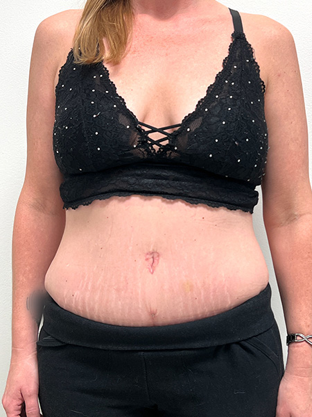 Abdominoplasty Before and After | Rashid Plastic Surgery