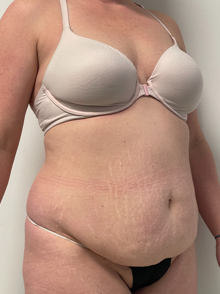 Abdominoplasty Before and After | Rashid Plastic Surgery