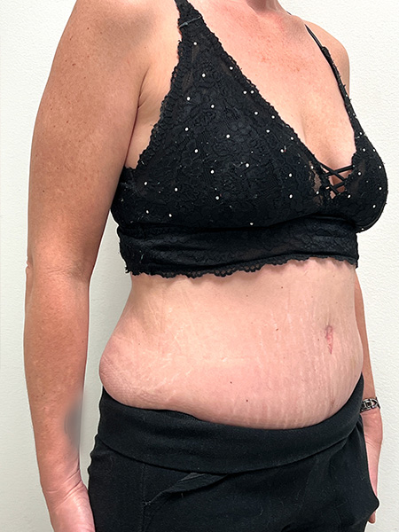 Abdominoplasty Before and After | Rashid Plastic Surgery