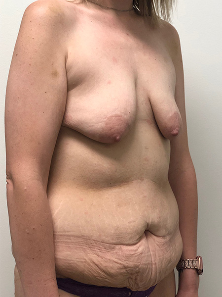 Abdominoplasty Before and After | Rashid Putman Plastic Surgery