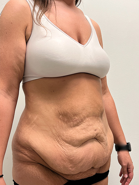 Abdominoplasty Before and After | Rashid Plastic Surgery