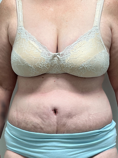 Abdominoplasty Before and After | Rashid Plastic Surgery