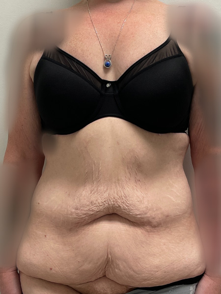 Abdominoplasty Before and After | Rashid Plastic Surgery