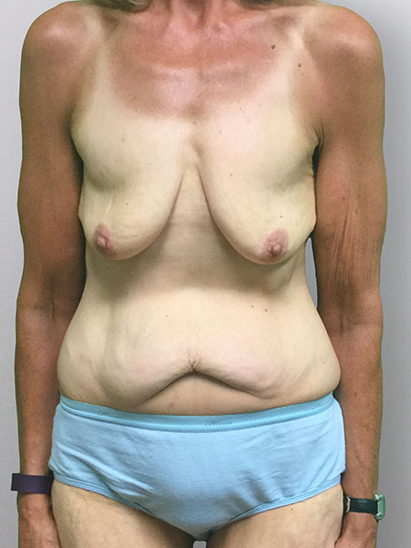 Abdominoplasty Before and After | Rashid Putman Plastic Surgery