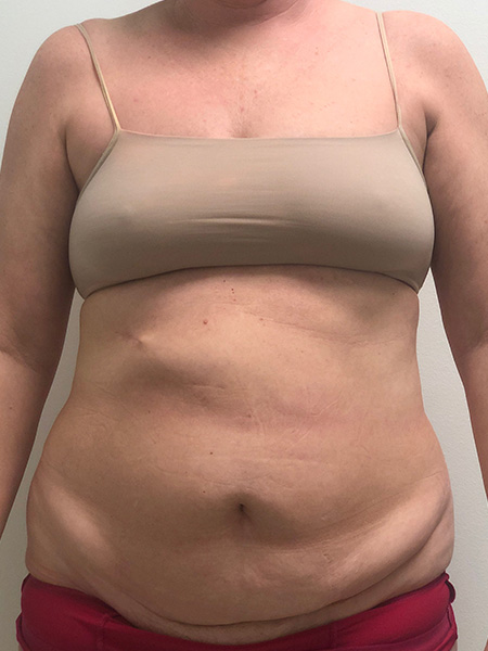 Abdominoplasty Before and After | Rashid Plastic Surgery