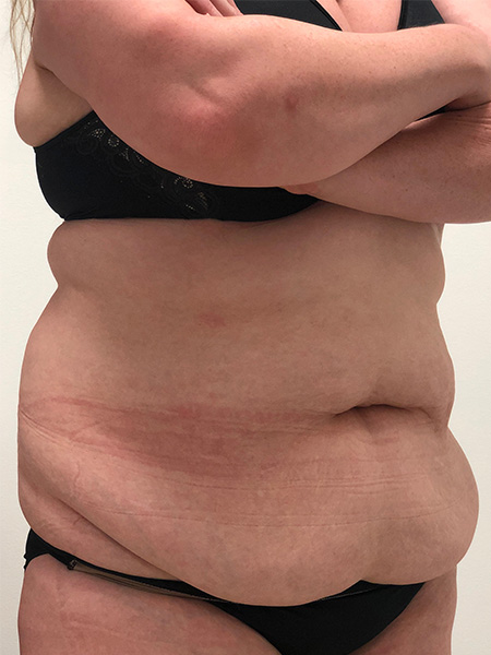 Abdominoplasty Before and After | Rashid Plastic Surgery