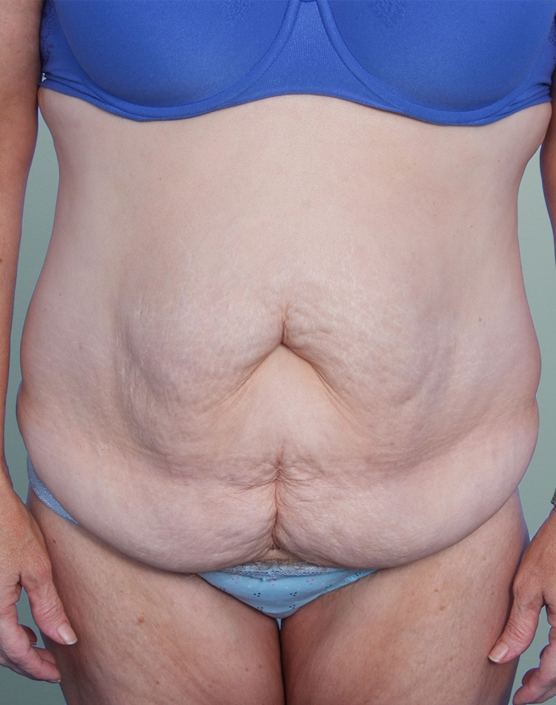 Abdominoplasty Before and After | Rashid Plastic Surgery