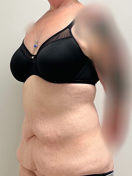 Abdominoplasty Before and After | Rashid Plastic Surgery