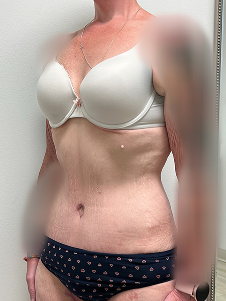 Abdominoplasty Before and After | Rashid Plastic Surgery