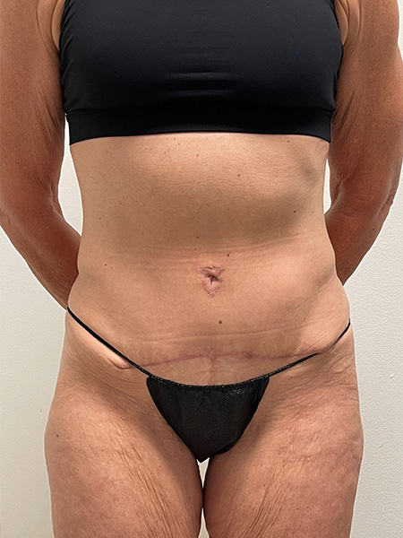 Abdominoplasty Before and After | Rashid Plastic Surgery