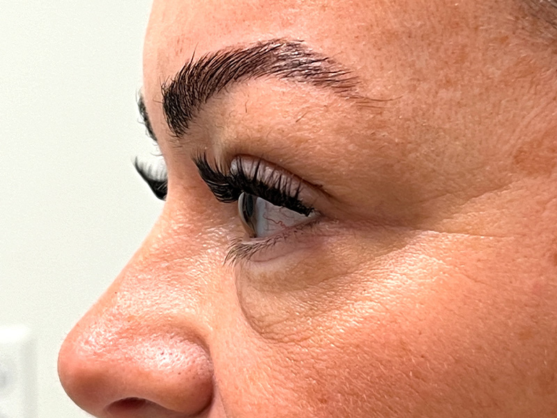 Blepharoplasty Before and After | Rashid Plastic Surgery