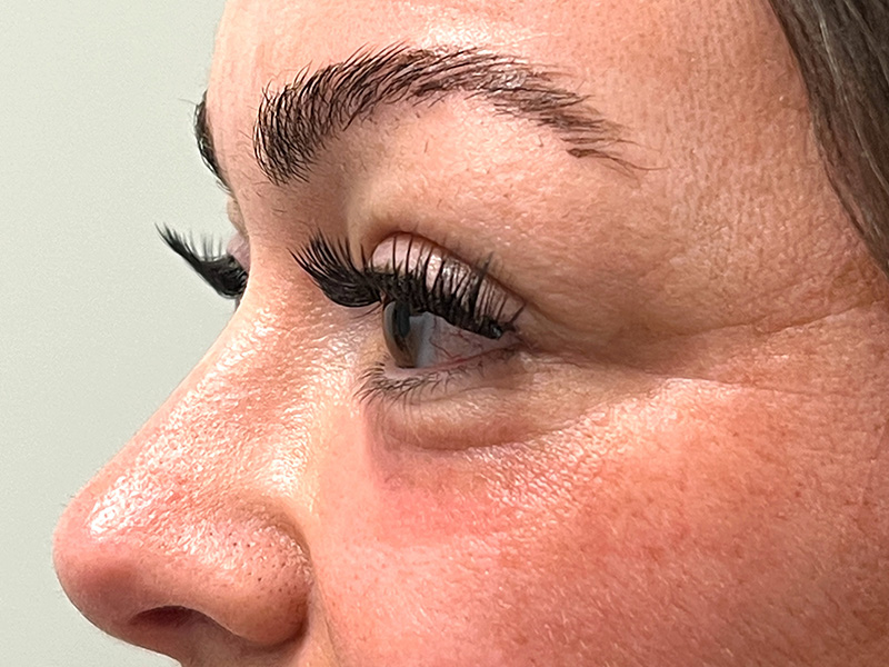 Blepharoplasty Before and After | Rashid Plastic Surgery