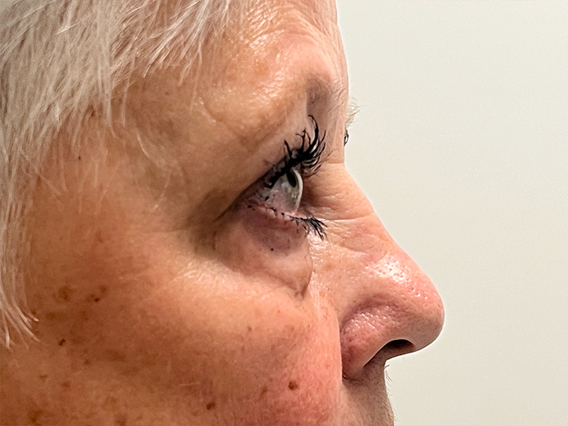 Blepharoplasty Before and After | Rashid Putman Plastic Surgery