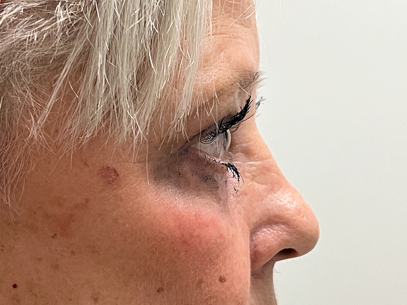 Blepharoplasty Before and After | Rashid Plastic Surgery