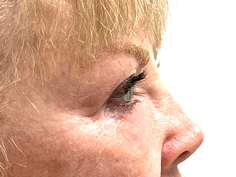 Blepharoplasty Before and After | Rashid Plastic Surgery