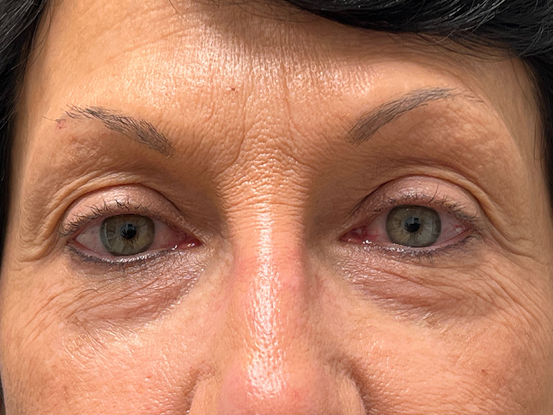 Blepharoplasty Before and After | Rashid Plastic Surgery