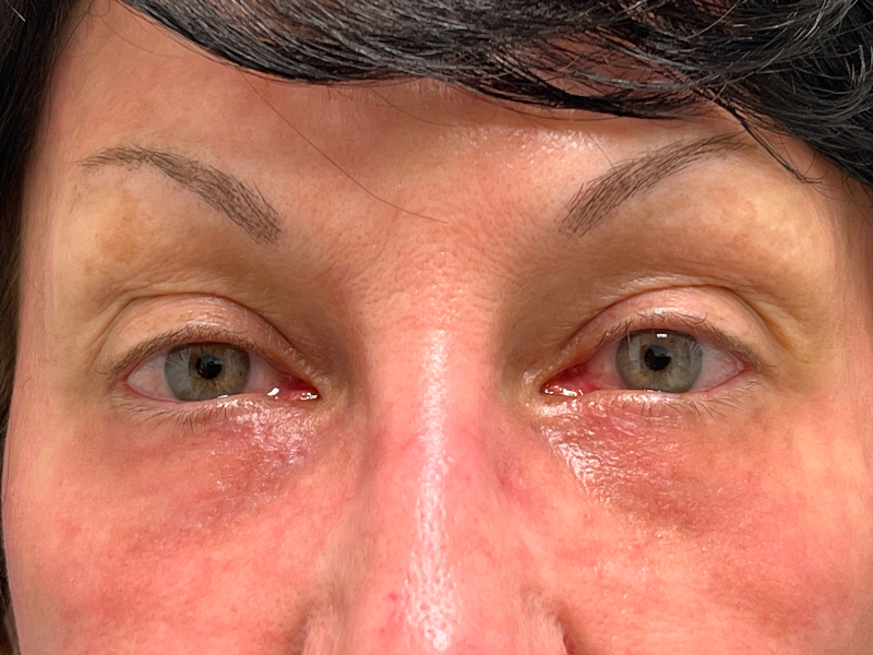 Blepharoplasty Before and After | Rashid Plastic Surgery