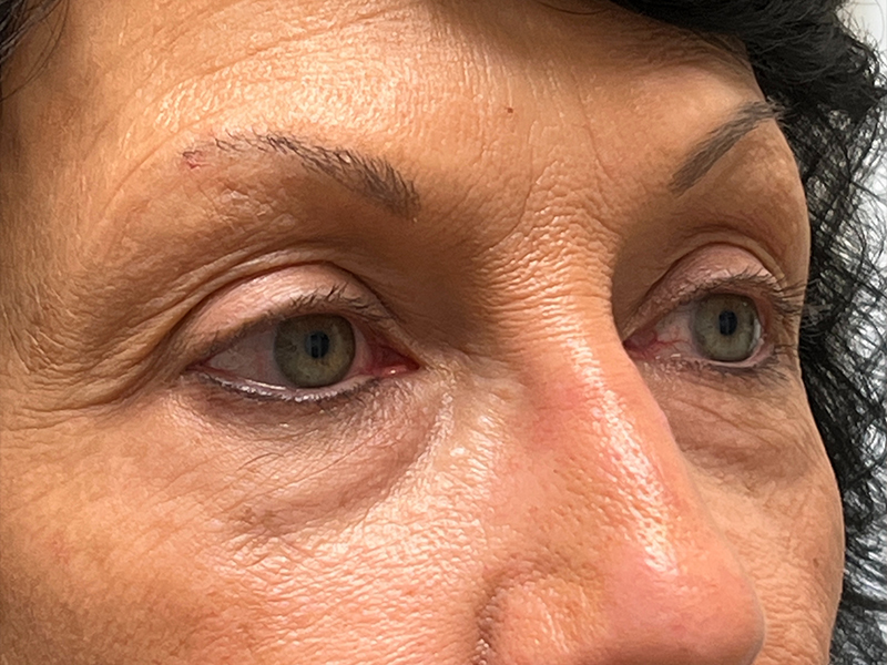 Blepharoplasty Before and After | Rashid Plastic Surgery