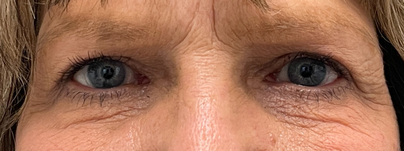 Blepharoplasty Before and After | Rashid Putman Plastic Surgery
