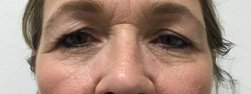 Blepharoplasty Before and After | Rashid Plastic Surgery