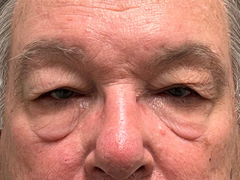 Blepharoplasty Before and After | Rashid Plastic Surgery