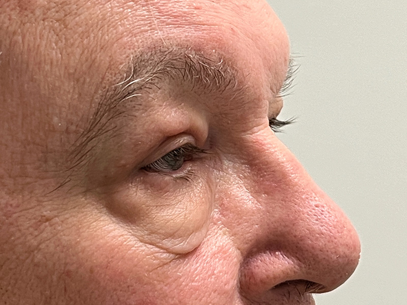 Blepharoplasty Before and After | Rashid Plastic Surgery