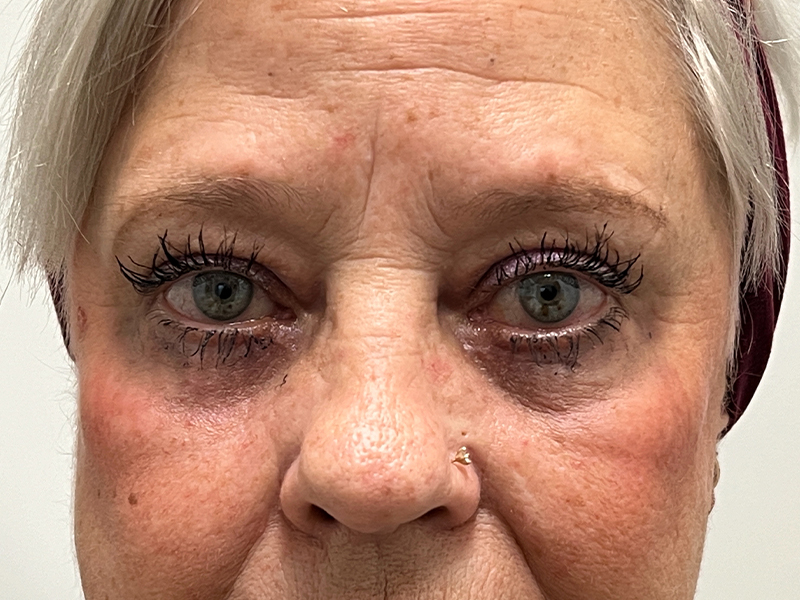 Blepharoplasty Before and After | Rashid Plastic Surgery