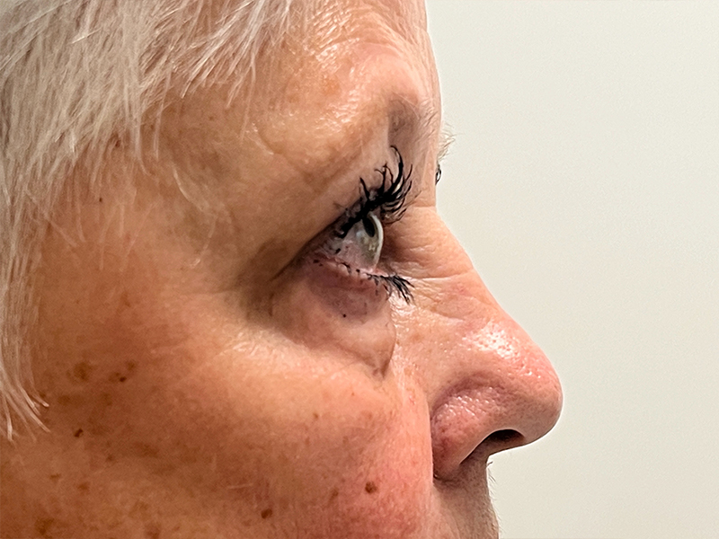 Blepharoplasty Before and After | Rashid Plastic Surgery