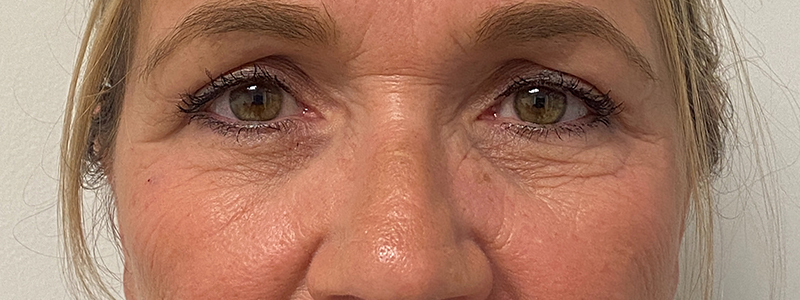 Blepharoplasty Before and After | Rashid Plastic Surgery