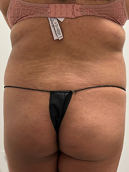 Brazilian Butt Lift Before and After | Rashid Plastic Surgery