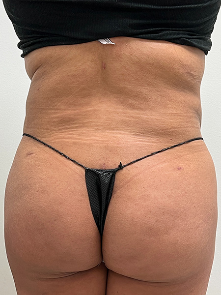 Brazilian Butt Lift Before and After | Rashid Plastic Surgery