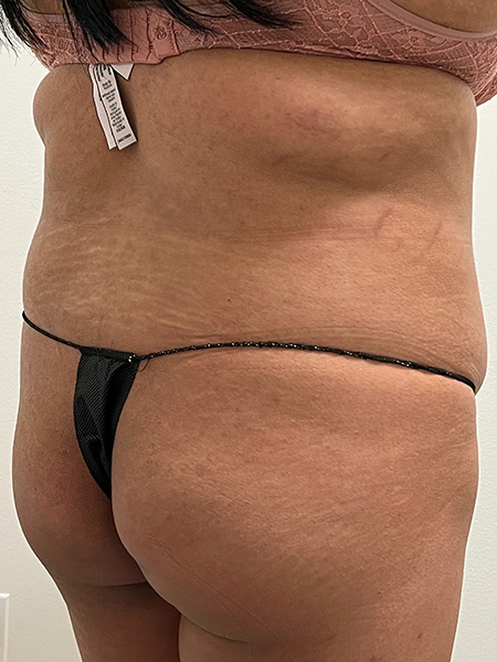 Brazilian Butt Lift Before and After | Rashid Plastic Surgery