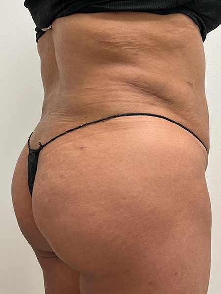 Brazilian Butt Lift Before and After | Rashid Plastic Surgery