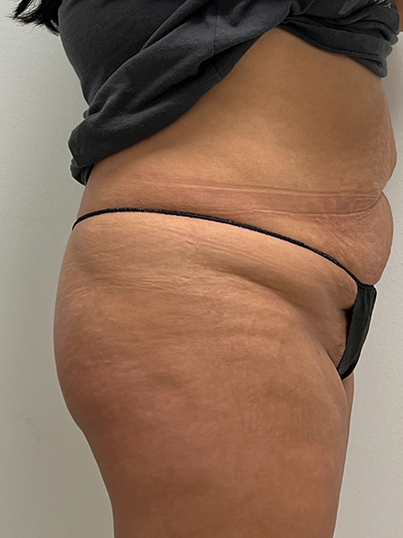 Brazilian Butt Lift Before and After | Rashid Plastic Surgery