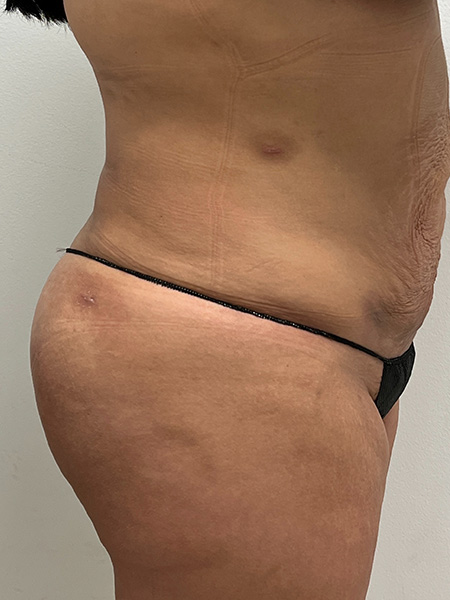 Brazilian Butt Lift Before and After | Rashid Plastic Surgery