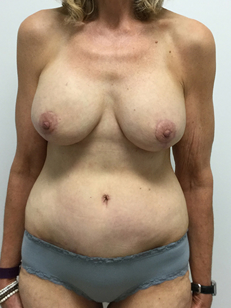 Breast Aug With Lift Before and After | Rashid Putman Plastic Surgery