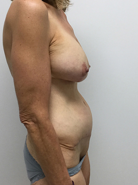 Breast Aug With Lift Before and After | Rashid Plastic Surgery