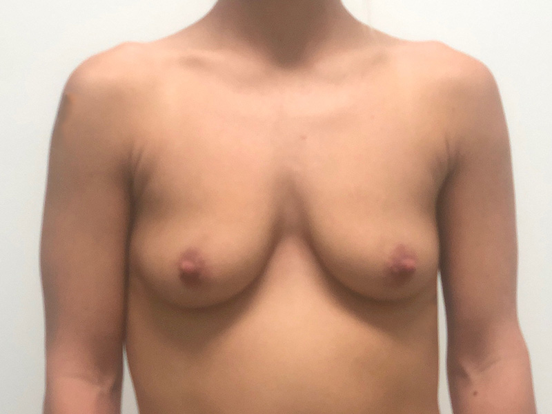 Breast Aug Before and After | Rashid Plastic Surgery