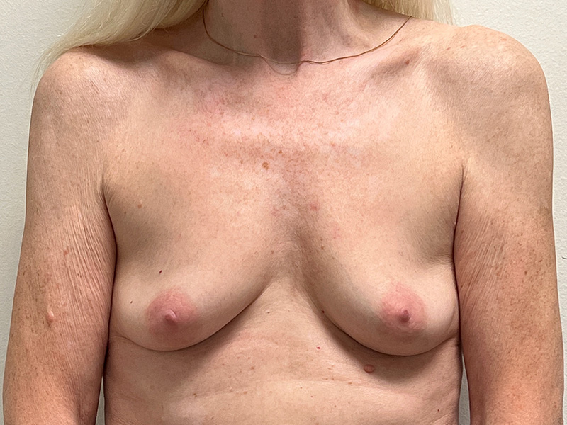 Breast Aug Before and After | Rashid Plastic Surgery