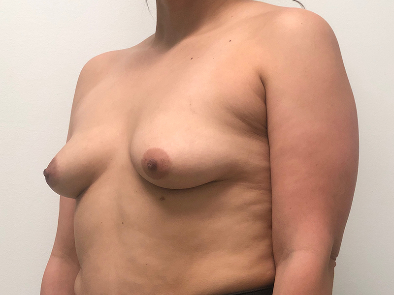 Breast Aug Before and After | Rashid Plastic Surgery