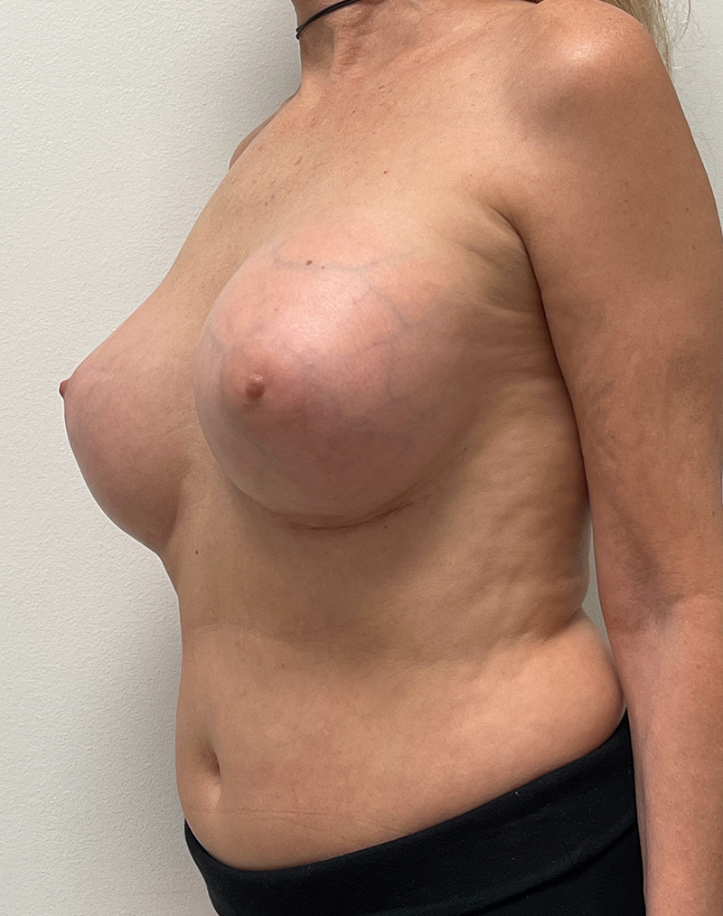 Breast Aug Before and After | Rashid Putman Plastic Surgery