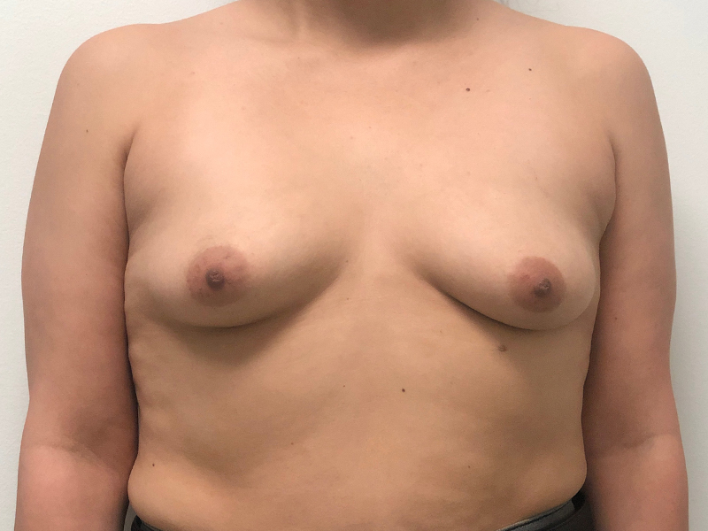 Breast Aug Before and After | Rashid Plastic Surgery