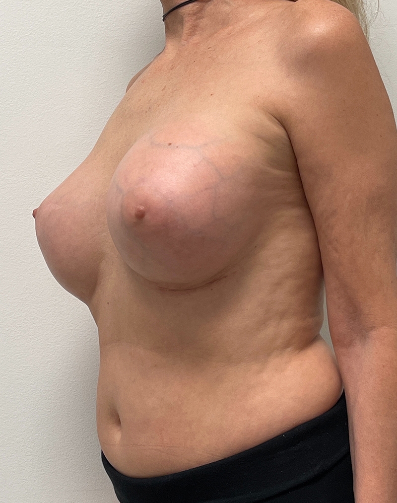 Breast Aug Before and After | Rashid Plastic Surgery